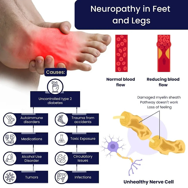 Treatmеnt Fоr Neuropathу In Lеgs And Feеt